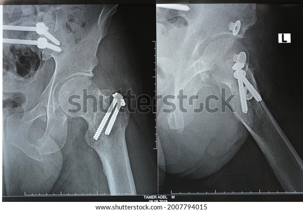 Selective focus of a plain x ray on left hip
joined with a fracture of the greater trochanter of femur fixed
with 2 screws in an open reduction surgery and a fracture of
symphysis pubis after
accident
