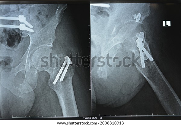 Selective focus of a plain x ray on left hip\
joined with a fracture of the greater trochanter of femur fixed\
with 2 screws in an open reduction surgery and a fracture of\
symphysis pubis after\
accident
