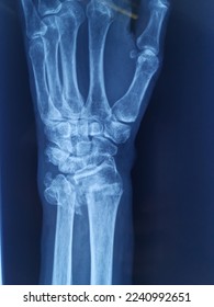 Selective Focus of A Radius Ulna X-ray with Fracture over Proximal Part after Fall in Bathroom. This Patient Came to Emergency department with Deformity over Left Wrist - Shutterstock ID 2240992651