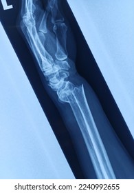 Selective Focus of A Radius Ulna X-ray with Fracture over Proximal Part after Fall in Bathroom. This Patient Came to Emergency department with Deformity over Left Wrist - Shutterstock ID 2240992655