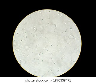 Semen Analysis, Sperm Analysis On Microscopic Examination. Micrograph Of Oligospermia