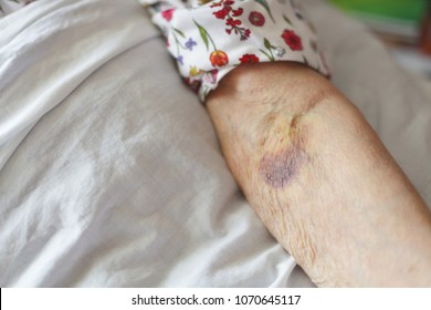 Bruises old age The Trauma