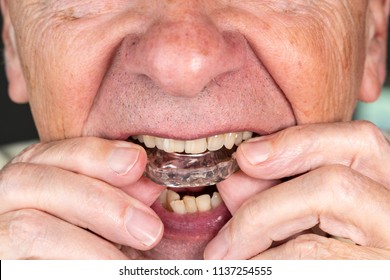 Senior Caucasian Man Putting Plastic Mouth Or Night Guard Onto Crooked Stained Teeth