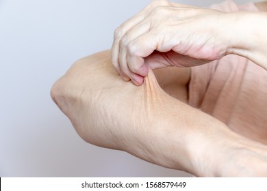 A Senior Elderly Woman Holding, Pulling The Skin On Her Arm With Bad Turgor, Exces Loose Skin.