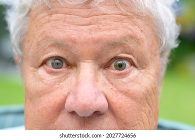 Senior man with anisocoria showing unequal dilation of his pupils in a close up view on his eyes as he stares into the lens caused by disease, trauma or brain tumour