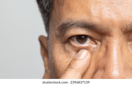 Senior man eyestrain after for long stretches at computer or digital screens. - Powered by Shutterstock