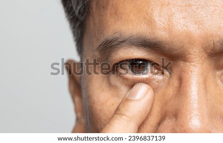Senior man eyestrain after for long stretches at computer or digital screens.