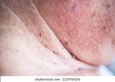 papiloma fibroepitelial acrochordon