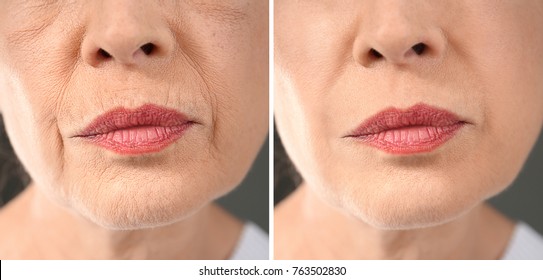 Senior woman before and after biorevitalization procedure, closeup - Powered by Shutterstock