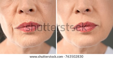 Senior woman before and after biorevitalization procedure, closeup