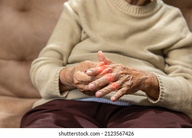 Senior Woman Massage Finger With Painful Swollen Gout