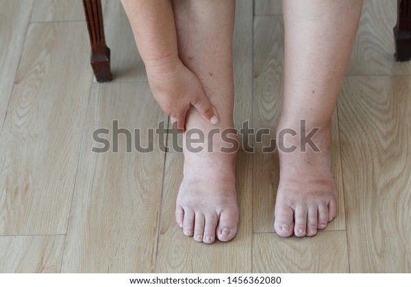 Senior woman swollen feet and\
leg