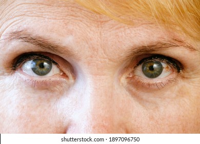 Senior Woman's Eyes, Closeup Of Irritated Red Bloodshot Eye, Closeup