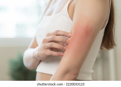 Sensitive Skin Allergic Concept, Woman Itching On Her Arm Have A Red Rash From Allergy Symptom And From Scratching.