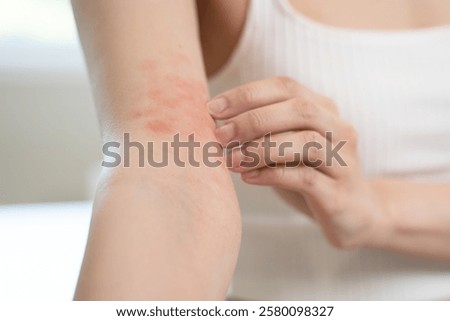 Sensitive skin allergic concept, Woman itching on her arm have a red rash from allergy symptom and from scratching.