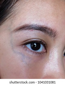 Sensitive Skin Problem Shown On Asian Skin Type. Dark Circle And Obvious Vein Around Under Eye Area Are Caused By Lack Of Sleep, DNA, Dehydration