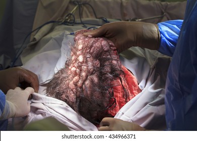 Separating the tumor of a head soft tissues during the surgery