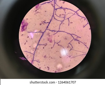 Septate hyphae of Aspergillus fumigatus from the pateint with severe combined immune deficiency and invasive aspergillosis with aspergillus pneumonia