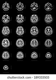 Sequence Of Horizontal Sections Of A Human Brain - MRI Scan