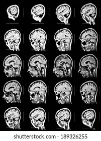 Sequence Of Vertical Sections Of A Human Brain - MRI Scan