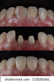 Serial shots of 2 beautiful all ceramic front teeth crowns try in and bonded intra oral to correct discoloured teeth.