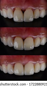 
Serial shots of 2 beautiful all ceramic front teeth crowns intra oral try in and installation
