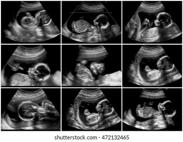 Series Of 9 Ultrasound Of 20 Weeks Fetus.