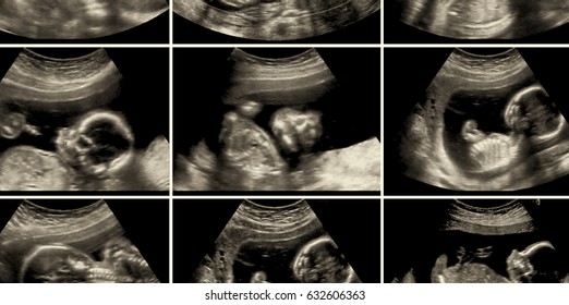 Series Of 9 Ultrasound Of 20 Weeks Fetus.