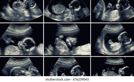 Series Of 9 Ultrasound Of 20 Weeks Fetus.