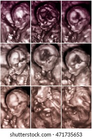 Series Of Nine 3D Fetus Ultrasonography Pictures.