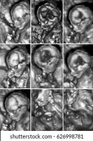 Series Of Nine 3D Fetus Ultrasonography Pictures.