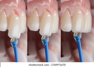 Series Shots Of Dental Veneer Placement And Installation On The Tooth.