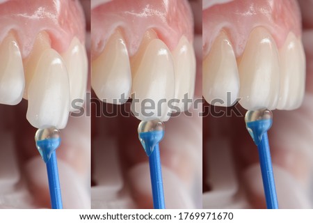 Series shots of dental veneer placement and installation on the tooth.