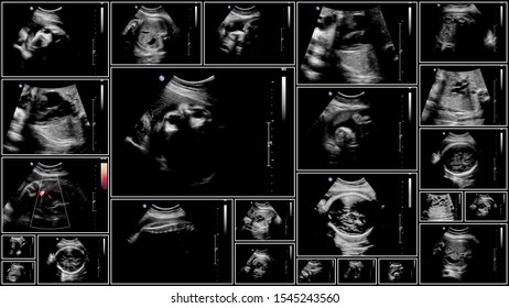 Series Of Ultrasonography Fetus Images. Pregnancy On 7th Month.