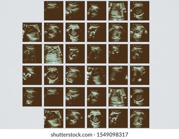 Series Of Ultrasonography Fetus Images. Pregnancy On 7th Month.