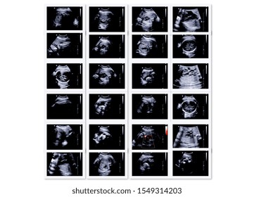 Series Of Ultrasonography Fetus Images. Pregnancy On 7th Month.