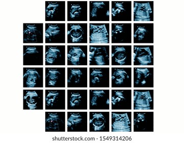 Series Of Ultrasonography Fetus Images. Pregnancy On 7th Month.