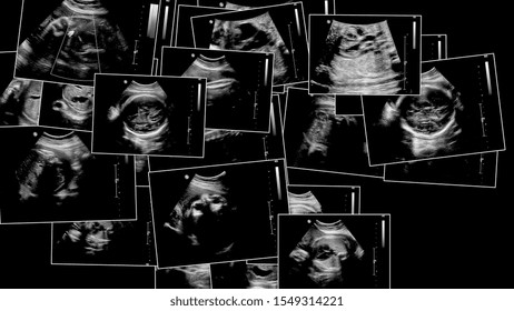 Series Of Ultrasonography Fetus Images. Pregnancy On 7th Month.