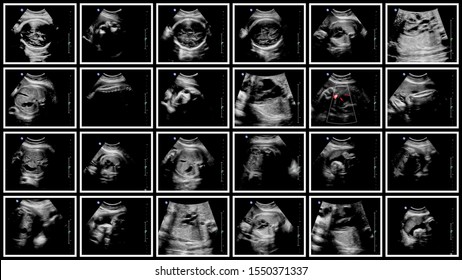 Series Of Ultrasonography Fetus Images. Pregnancy On 7th Month.