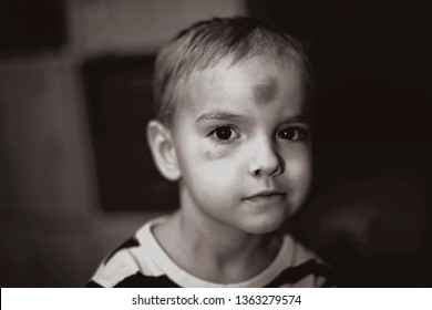 Serious Toddler Blond Boy Big Bruise Stock Photo (Edit Now) 1363279574