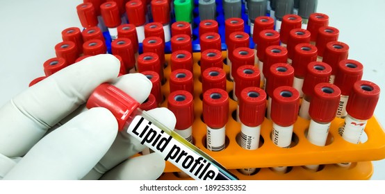 Serum Lipid Profile Essential Biochemistry Test Important For Thous Who Are Fatty In Body Sample Tube With Patient Fresh Blood Sample