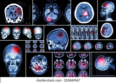 Set , Collection Of Brain Disease ( Cerebral Infarction , Hemorrhagic Stroke , Brain Tumor , Disc Herniation With Spinal Cord Compression ,etc)( CT Scan , MRI , MRT )( Neurology And Nervous System )