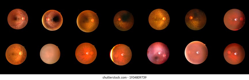 SET of Photo Madical Retina Normal isolated on black background.Diabates retinopathy.Human eye anatomy taking images with Mydriatic Retinal cameras.