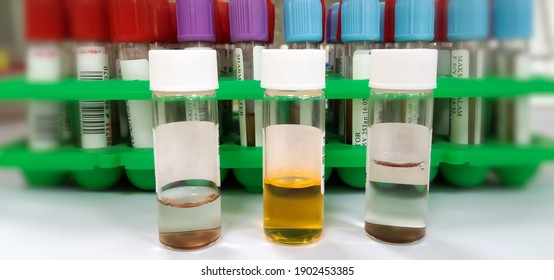 Eine Durchstechflasche mit farbigen Reagenslösungen in einem echten medizinischen Labor. bunter Hintergrundprobe.