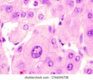 Several Hepatocytes Showing Very Large Nuclei. These Cells Are Polyploid, With 4, 8 Or More Times The Haploid Chromosome Complement.