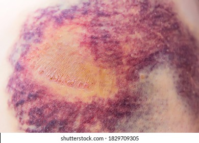 Severe bruise. Close-up - a hematoma on a woman's thigh after a severe injury. limited accumulation of blood with rupture of blood vessels. consequences of a strong fall on the outer thigh.