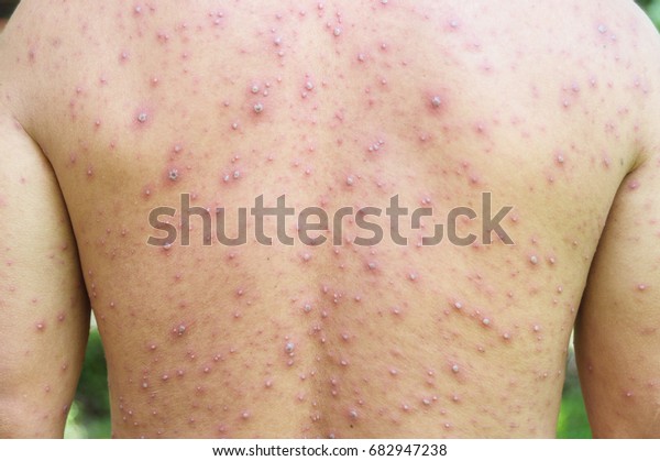 Penyakit kulit Cacar Air parah (varicella) di seluruh tubuh pria dewasa Asia.