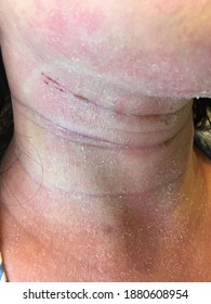 Severe eczema on a woman