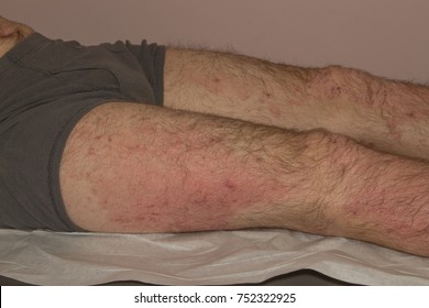 Severe Eczema Skin Disease, Atopic Dermatitis, In A Twenty-four Year Old Caucasian Male With Multiple Allergies