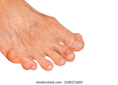 Severe gout in men suffering from joint pain, bone pain, gout, rheumatoid symptoms, radioactive sickness, ill man concept of male osteoporosis, injured bone, injury, pain, arthritis,arm, foot, knee - Shutterstock ID 2108171603